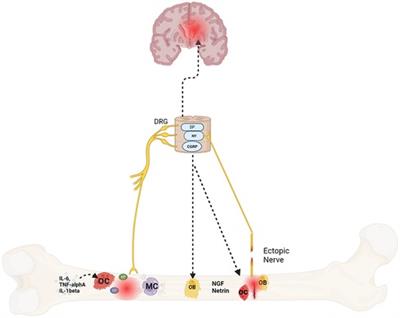 A bone to pick-cellular and molecular mechanisms of bone pain in sickle cell disease